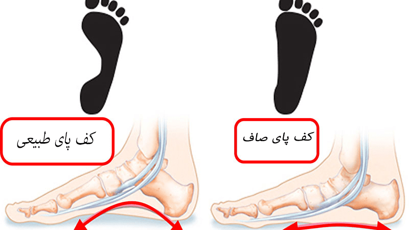 فیزیوتراپی صافی کف پا